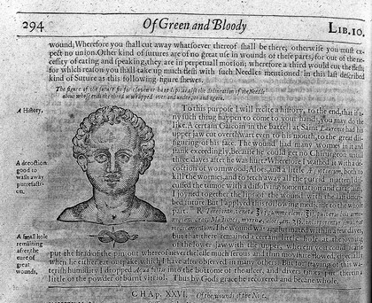 The workes of that famous chirurgion Ambrose Parey ... / Translated out of Latine and compared with the French by Tho. Johnson [and in part by G. Baker] Whereunto are added three tractates out of Adrianus Spigelius of the veines, arteries, and nerves. With large figures. ; Also a table of the bookes and chapters.