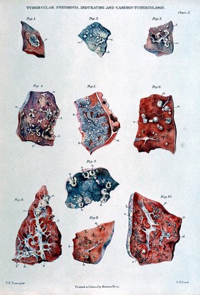 An atlas of the pathological anatomy of the lungs / by the late Wilson Fox.