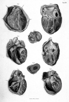 The heart, it's cavities and valves. Fig. 1 - Anterior surface of Heart and Pericardial covering., Fig. 2 - Posterior surface of Heart, Auricles, and Ventricales, Fig. 3 - Internal cavities of Ventricals - anterior view, Fig. 4 - Anterior surface of Heart - interior of right auricle exposed, Fig 5 - Interior of right Auricle, Ventrical, and Pulmonary Artery, Fig. 6 - Exterior of left Ventricle and of Aorta, Fig. 7 - Transverse section of Auricles, Aorta, and Pulmonary Artery, immediately above the origins of these vessels, showing the auriculo-ventricular and arterial valves in action, Fig. 8 - Transverse section of Ventricles.