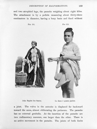 Human monstrosities / by Barton Cooke Hirst and George A. Piersol.
