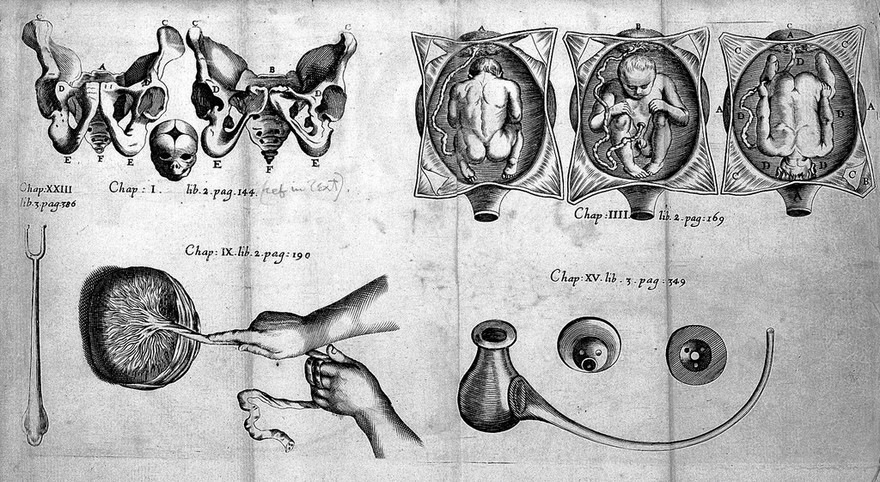 The accomplisht midwife, treating of the diseases of women with child, and in child-bed. As also, the best directions how to help them in natural and unnatural labours. With fit remedies for ... indispositions of new-born babes ... / Translated, and enlarged with ... marginal-notes, by Hugh Chamberlen.