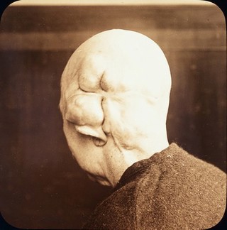 Lantern slide: Wens (head): malignant?