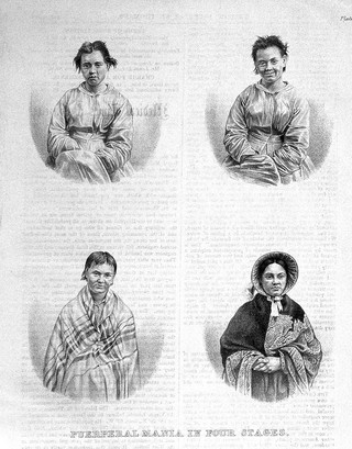 Medical Times Gazette, "Puerperal mania in four stages".