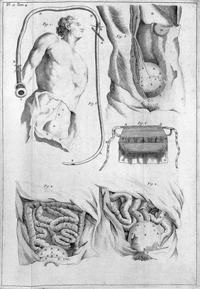 Dictionnaire universel de medecine, de chirurgie, de chymie, de botanique, de pharmacie, d'histoire naturelle, etc / Précédé d'un discours historique sur l'origine et les progres de la medecine. Traduit de l'anglois ... par Mrs Diderot, Eidous et Toussaint. Revu, corrigé et augmenté par M.J. Busson.