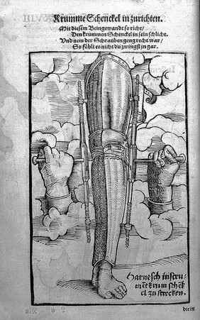 Gersdorff, Feldtbuch der Wundartzney, 1527