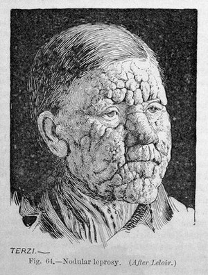 view Patrick Manson, Tropical Diseases, Nodular leprosy.