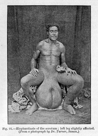 Tropical Diseases, Elephantiasis of the scrotum.