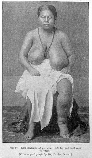 view Tropical Diseases, Elephantiasis of mammae.