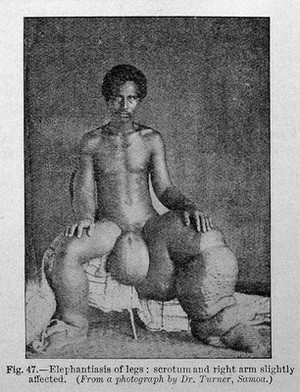 view Tropical Diseases, Elephantiasis of legs.