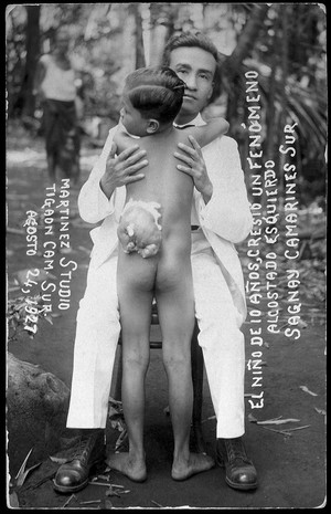 view A child of ten years with a parasitic attachment on its back, Sagñay, Camarines Sur, the Philippines. Photograph by Martinez Studio, 1927.