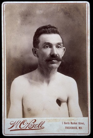 view Reverend Eavens, a man with a hole in his chest. Albumen print by W.C. Bell.