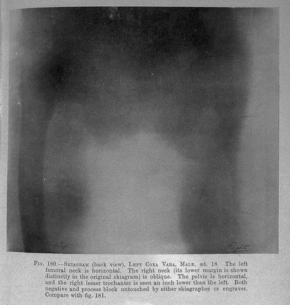 C. B. Keetley, Orthopaedic surgery