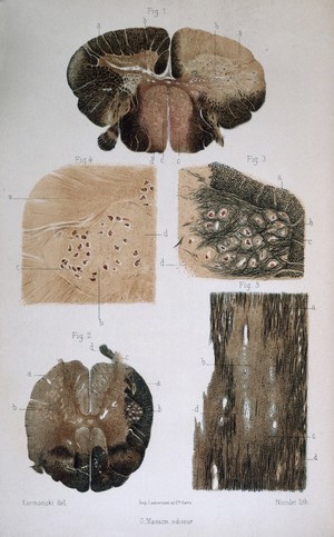 view Dr. J. Babinski, Sclerose en plaques