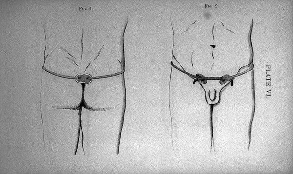 A treatise on hernia, explaining its varieties, situation, symptoms, and causes : to which is added a full description of the construction and application of the most approved mechanical remedies / By G.S. Acret, truss maker, 39, Houndsditch.