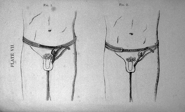 A treatise on hernia, explaining its varieties, situation, symptoms, and causes : to which is added a full description of the construction and application of the most approved mechanical remedies / By G.S. Acret, truss maker, 39, Houndsditch.