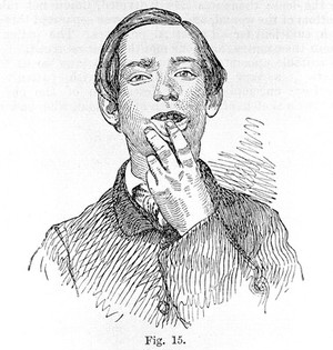 view Diseases of the jaw, etching,1887.