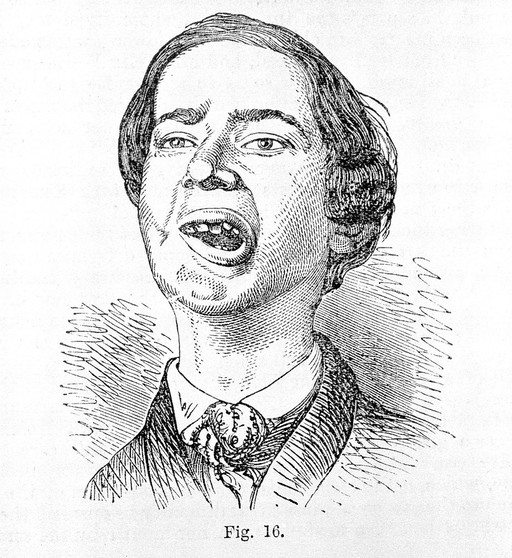 Diseases of the jaw, etching,1887.