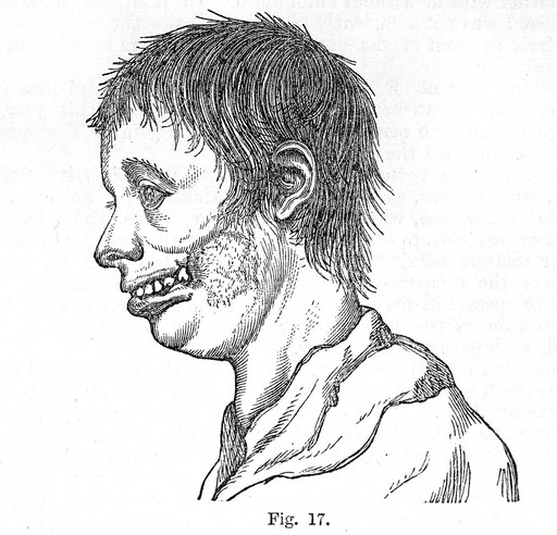 Diseases of the jaw, etching,1887.