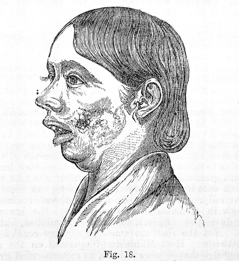 Diseases of the jaw, etching,1887. Collection