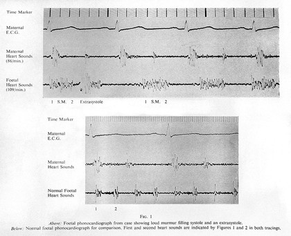 Foetel phonocardiograph from case showing