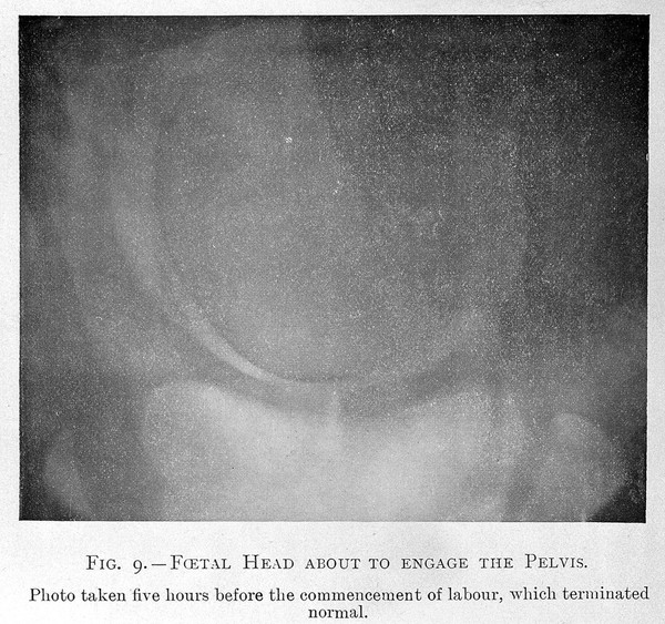 X-ray of foetal head about to engage the pel