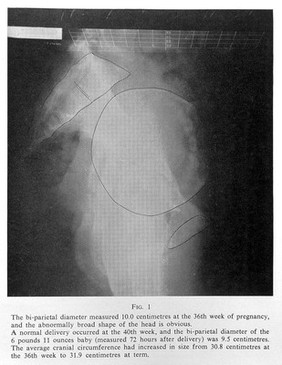 x-ray of bi-parietal diameter at 36 week of