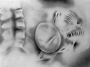 view Half-tone drawing of x-ray showing outline o