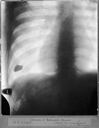 Ribs with a large foreign body or infection on the left side of the thorax. Radiograph.