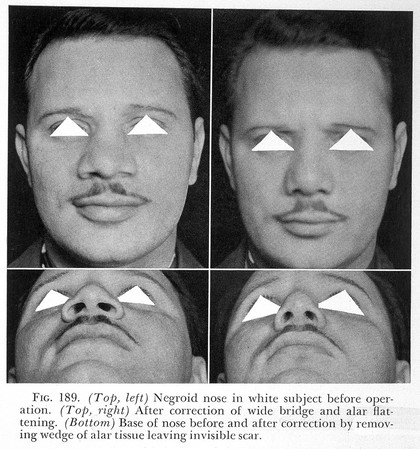 Plastic surgery of the nose / by Albert P. Seltzer.