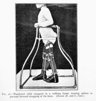 R.W.Lovett, Treatment of Infantile Paralysis