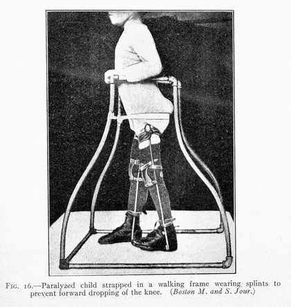 R.W.Lovett, Treatment of Infantile Paralysis