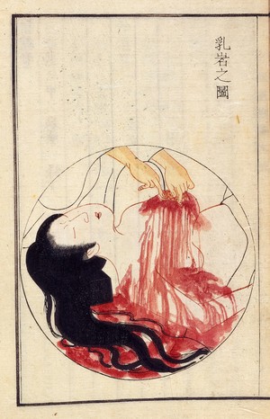 view Illustration shows the excision of a cancerous growth from a woman's breast, an operation which Hanaoka Seishu first carried out in 1804 using general anasthetic