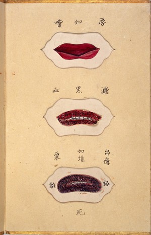 view Illustration showing various kinds of discoloration of the lips due to smallpox