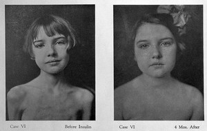 view Cases before and after insulin treatment