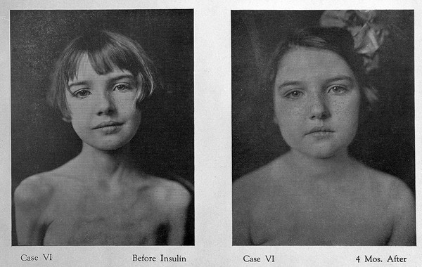 Cases before and after insulin treatment