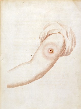 Jenner, An inquiry into the causes & effects