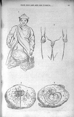 view Poor Hoo Loo and His Tumour, from The Lancet