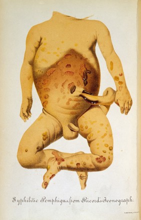 P.Diday, A Treatise on Syphilis in New-born