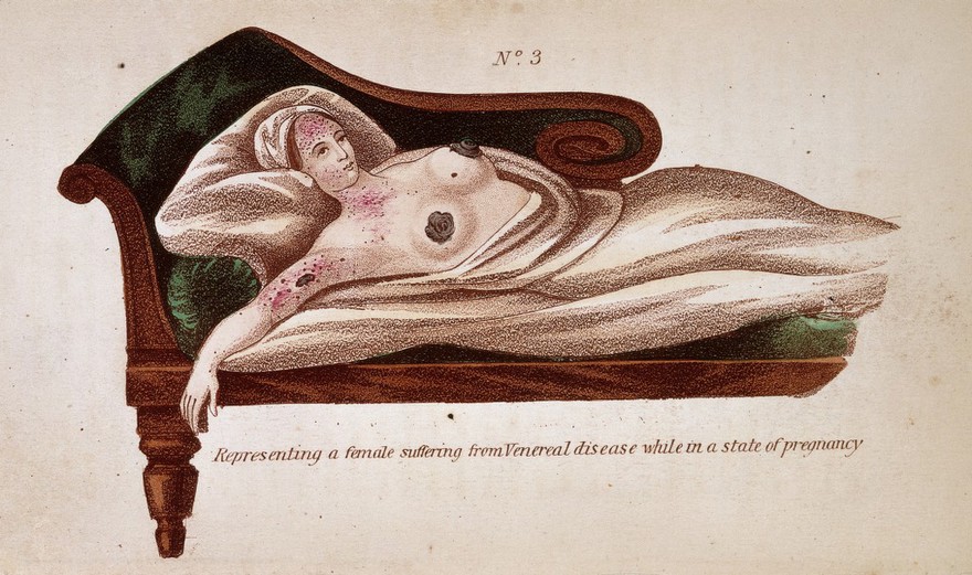 Representing a female suffering from Venereal disease while in a state of pregnancy