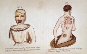 view (Left) Representing the face of a child where it has inherited consitutional disease from the mother. (Right) Representing ulcerations of the body during the earlier stage of syphilis