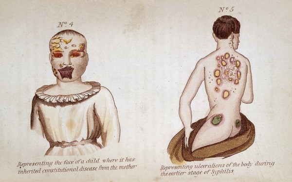 (Left) Representing the face of a child where it has inherited consitutional disease from the mother. (Right) Representing ulcerations of the body during the earlier stage of syphilis