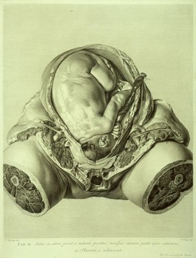 W. Hunter, Anatomia uteri gravidi, 1774