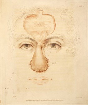 An account of two successful operations for restoring a lost nose from the integuments of the forehead in the cases of two officers of His Majesty's Army; to which are prefixed historical and physiological remarks on the nasal operation; including descriptions of the Indian and Italian methods / [J.C. Carpue].