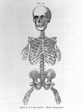 ABNORMALITIES: Skeleton of a phocomelus.