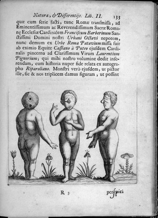 Cyclopic Infant