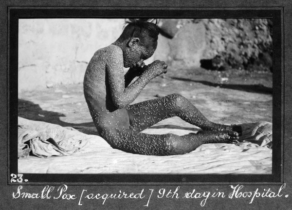 Smallpox epidemic, Palestine: a boy covered with smallpox pustules. Photograph, 1922.