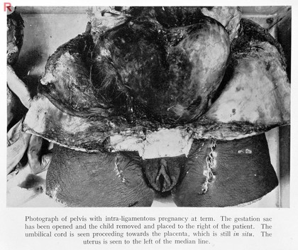 Photograph of pelvis with intra-ligamentous