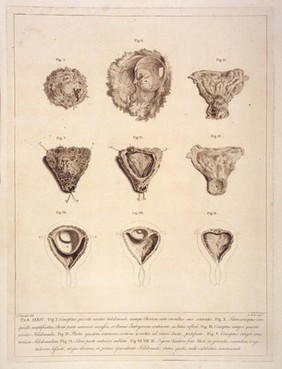 W. Hunter, Anatomia uteri humani gravidi tab