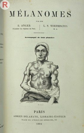 Frontispiece of Anger and Worthington's book titled Melanomes