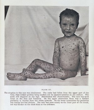 view Young boy with smallpox